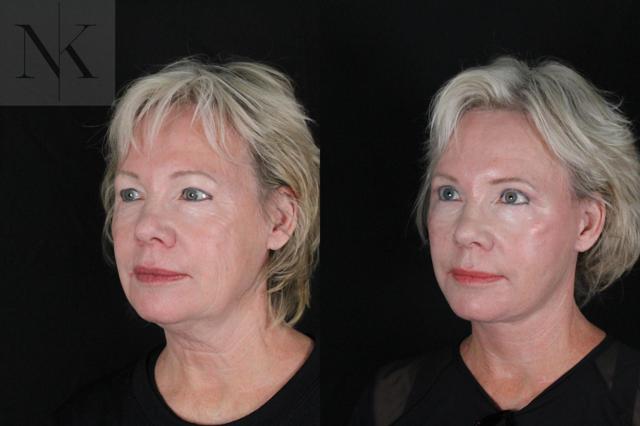 Facelift result at Karter Advanced Facial Plastic Surgery: Nicholas Karter, MD in Glastonbury, CT