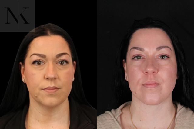 Neck Lift result at Karter Advanced Facial Plastic Surgery: Nicholas Karter, MD in Glastonbury, CT
