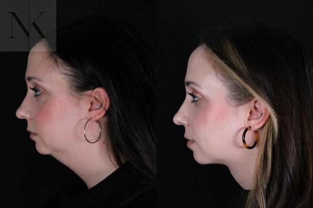 Neck Lift result at Karter Advanced Facial Plastic Surgery: Nicholas Karter, MD in Glastonbury, CT