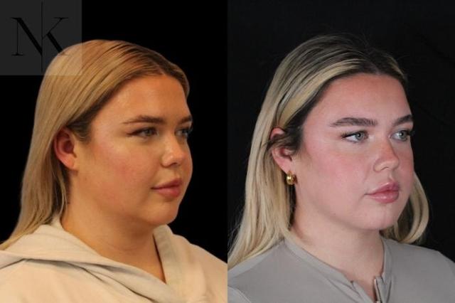 Neck Lift result at Karter Advanced Facial Plastic Surgery: Nicholas Karter, MD in Glastonbury, CT