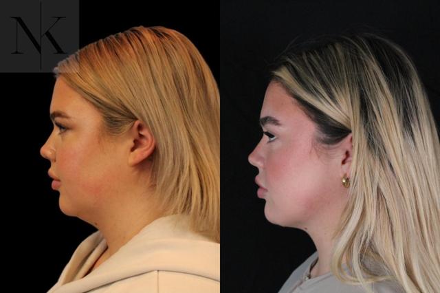 Neck Lift result at Karter Advanced Facial Plastic Surgery: Nicholas Karter, MD in Glastonbury, CT