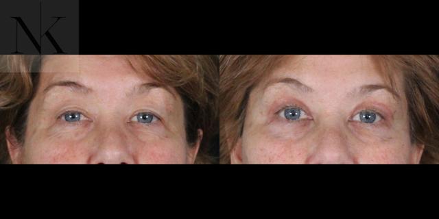 Blepharoplasty result at Karter Advanced Facial Plastic Surgery: Nicholas Karter, MD in Glastonbury, CT