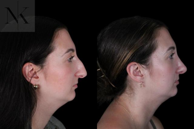 Rhinoplasty result at Karter Advanced Facial Plastic Surgery: Nicholas Karter, MD in Glastonbury, CT