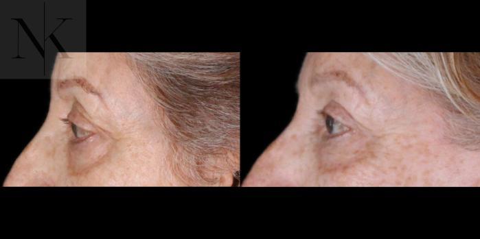 Karter Advanced Facial Plastic Surgery: Nicholas Karter, MD blepharoplasty result — Glastonbury, CT