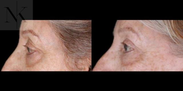Blepharoplasty result at Karter Advanced Facial Plastic Surgery: Nicholas Karter, MD in Glastonbury, CT