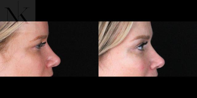 Brow Lift result at Karter Advanced Facial Plastic Surgery: Nicholas Karter, MD in Glastonbury, CT