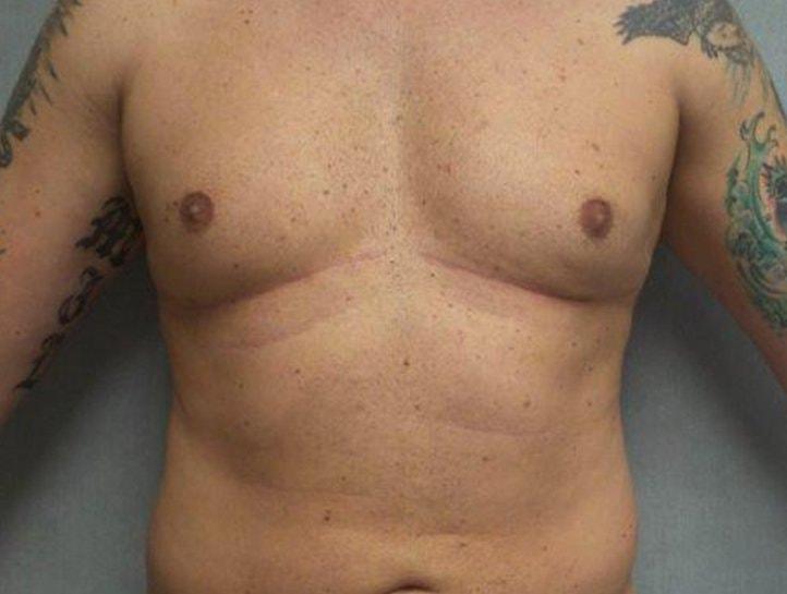 EBS Plastic Surgery gynecomastia after — New York, NY