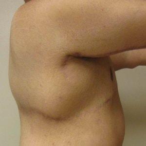 EBS Plastic Surgery gynecomastia after — New York, NY