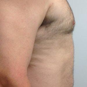 EBS Plastic Surgery gynecomastia after — New York, NY