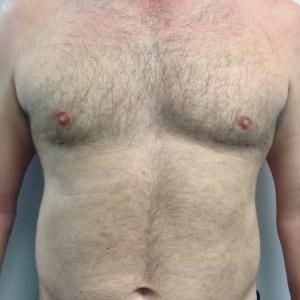 EBS Plastic Surgery gynecomastia after — New York, NY