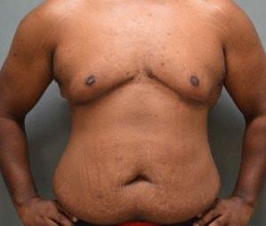 EBS Plastic Surgery gynecomastia after — New York, NY