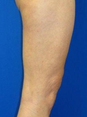 EBS Plastic Surgery skin tightening after — New York, NY