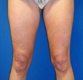 EBS Plastic Surgery skin tightening after — New York, NY