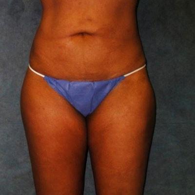 Belmont Plastic Surgery liposuction after — Chevy Chase, MD