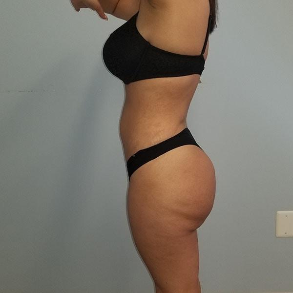 Belmont Plastic Surgery liposuction after — Chevy Chase, MD