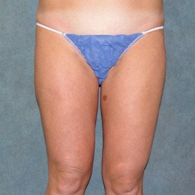 Belmont Plastic Surgery liposuction after — Chevy Chase, MD
