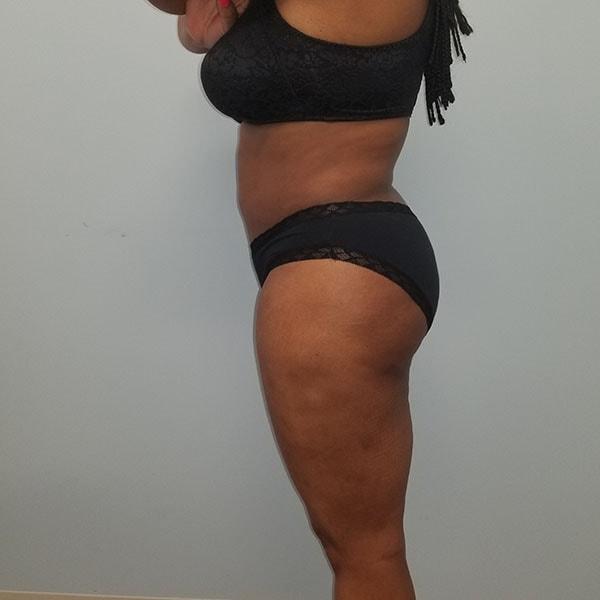 Belmont Plastic Surgery liposuction after — Chevy Chase, MD