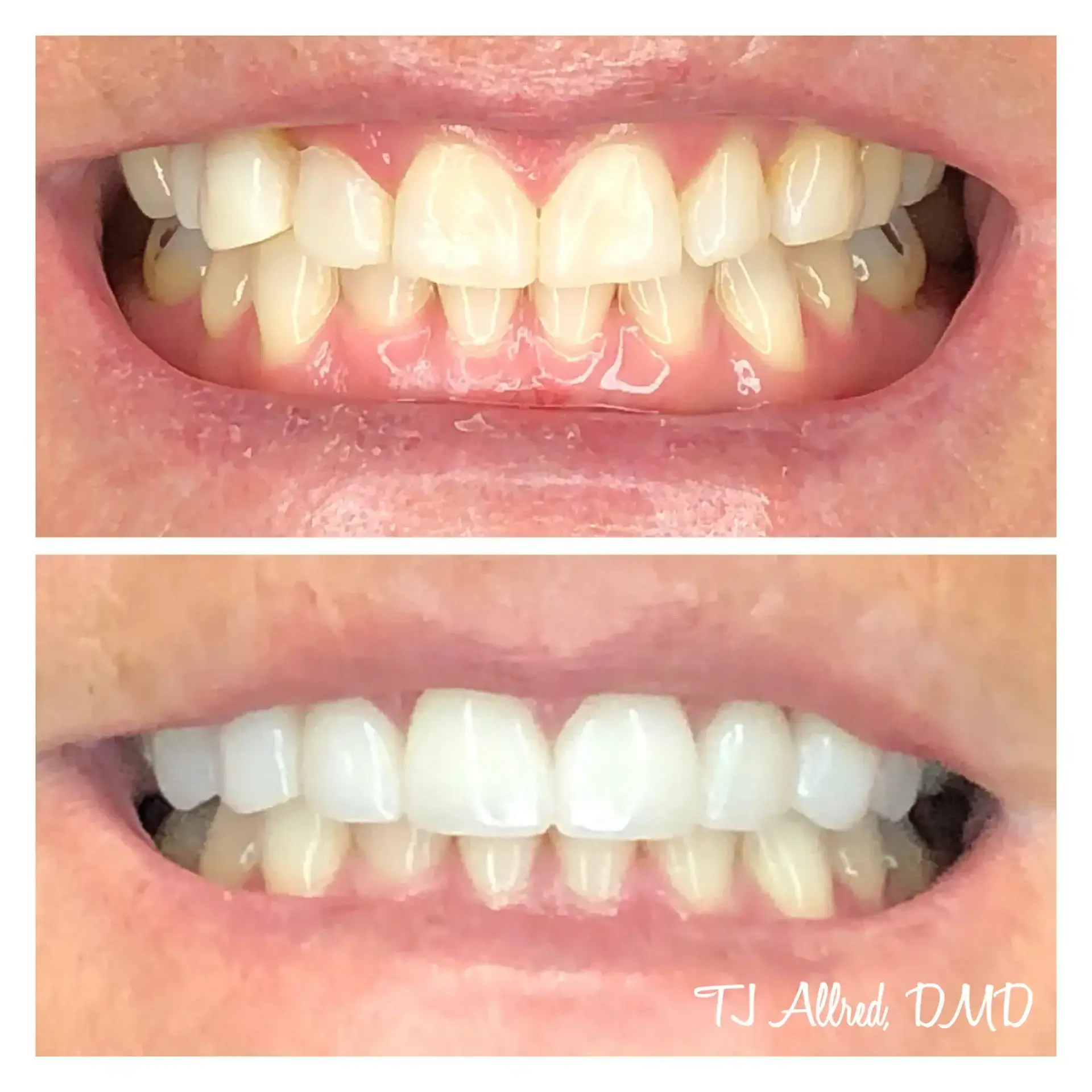 Velux Dental - SLC smile makeover result — Salt Lake City, UT