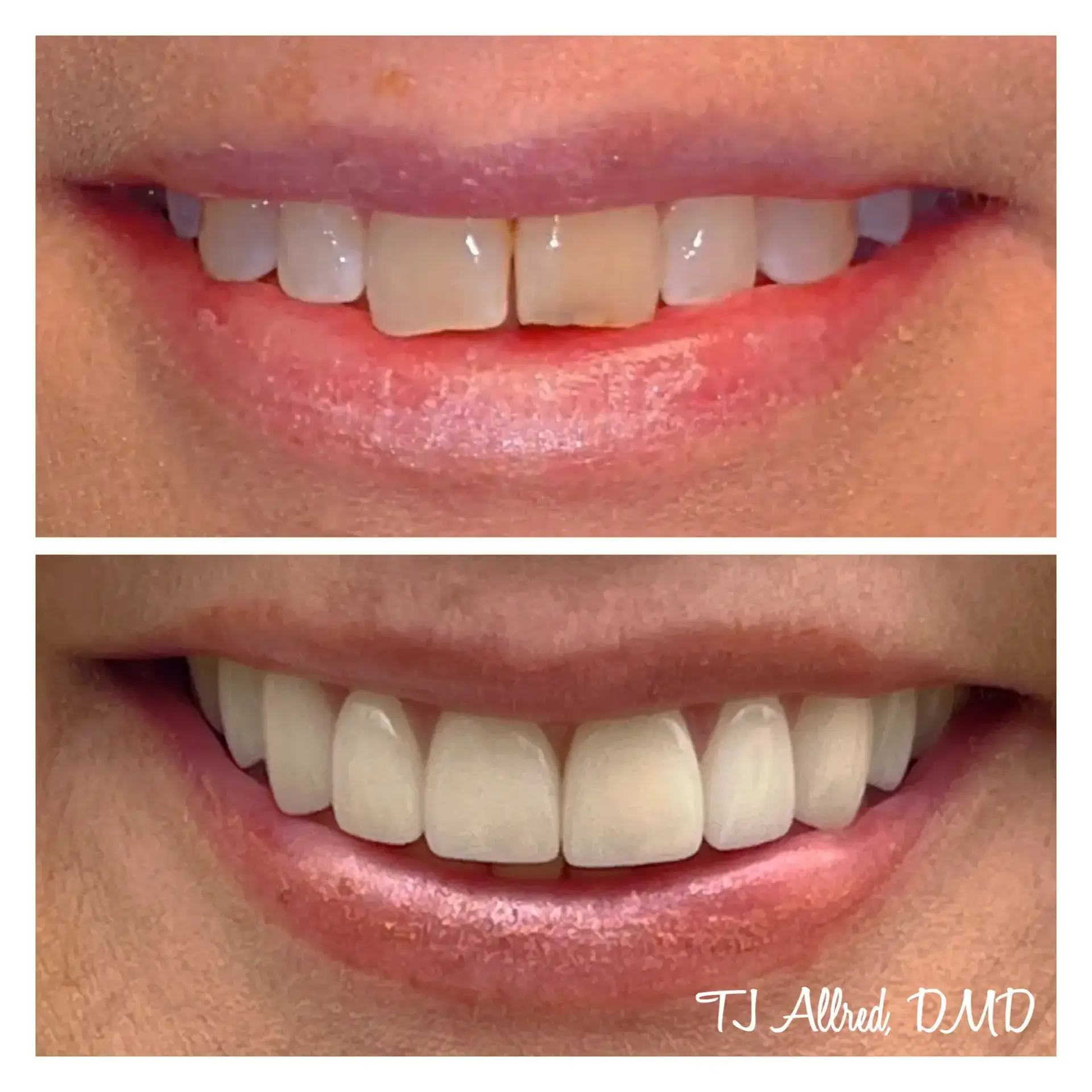 Velux Dental - SLC smile makeover result — Salt Lake City, UT
