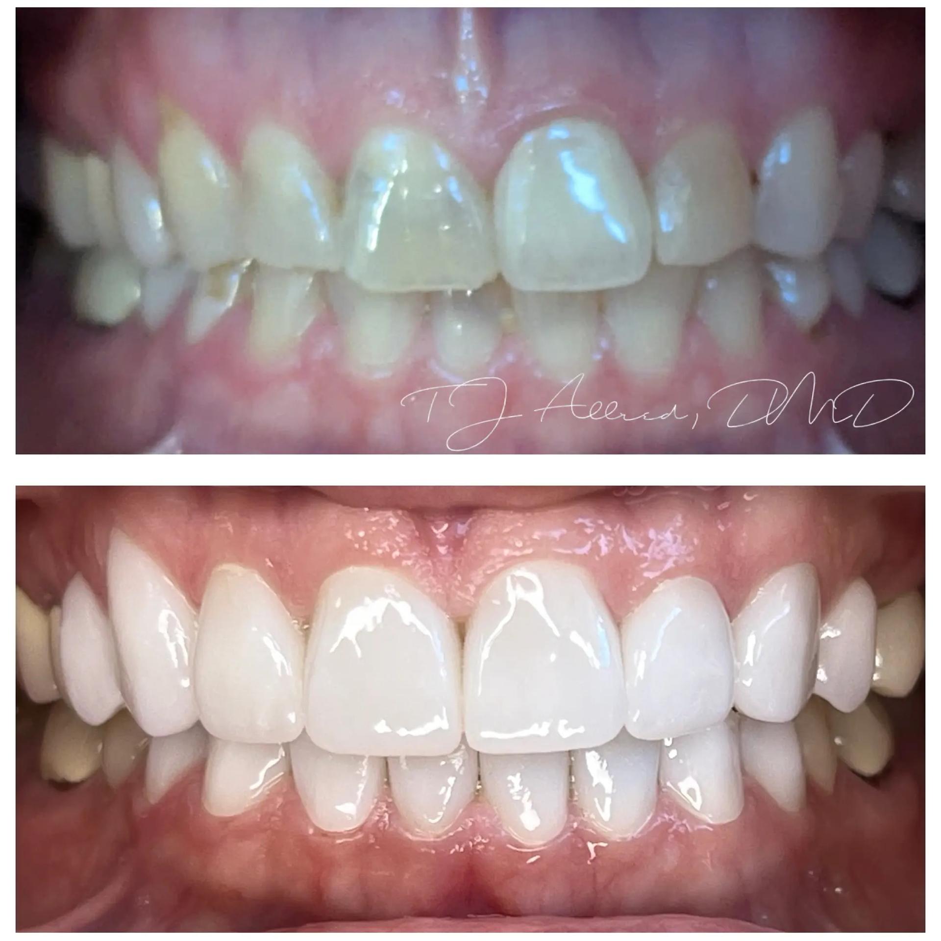 Velux Dental - SLC smile makeover result — Salt Lake City, UT