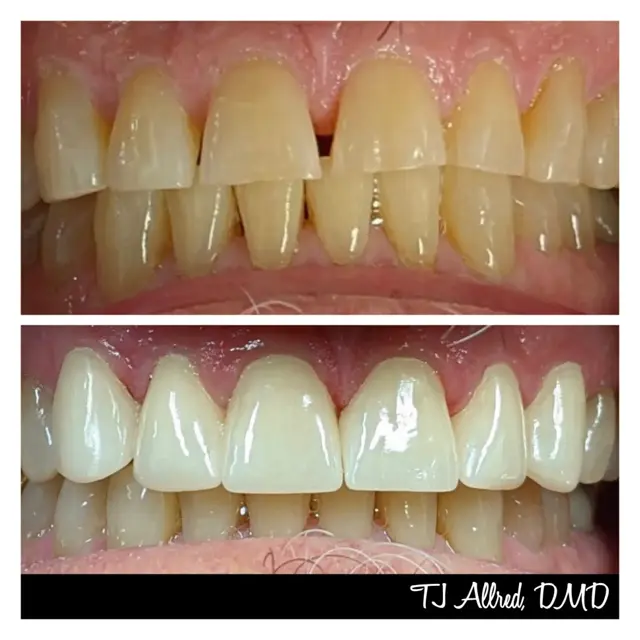 Smile Makeover result at Velux Dental - SLC in Salt Lake City, UT