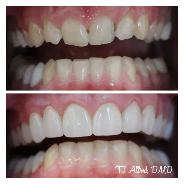 Smile Makeover result at Velux Dental - SLC in Salt Lake City, UT