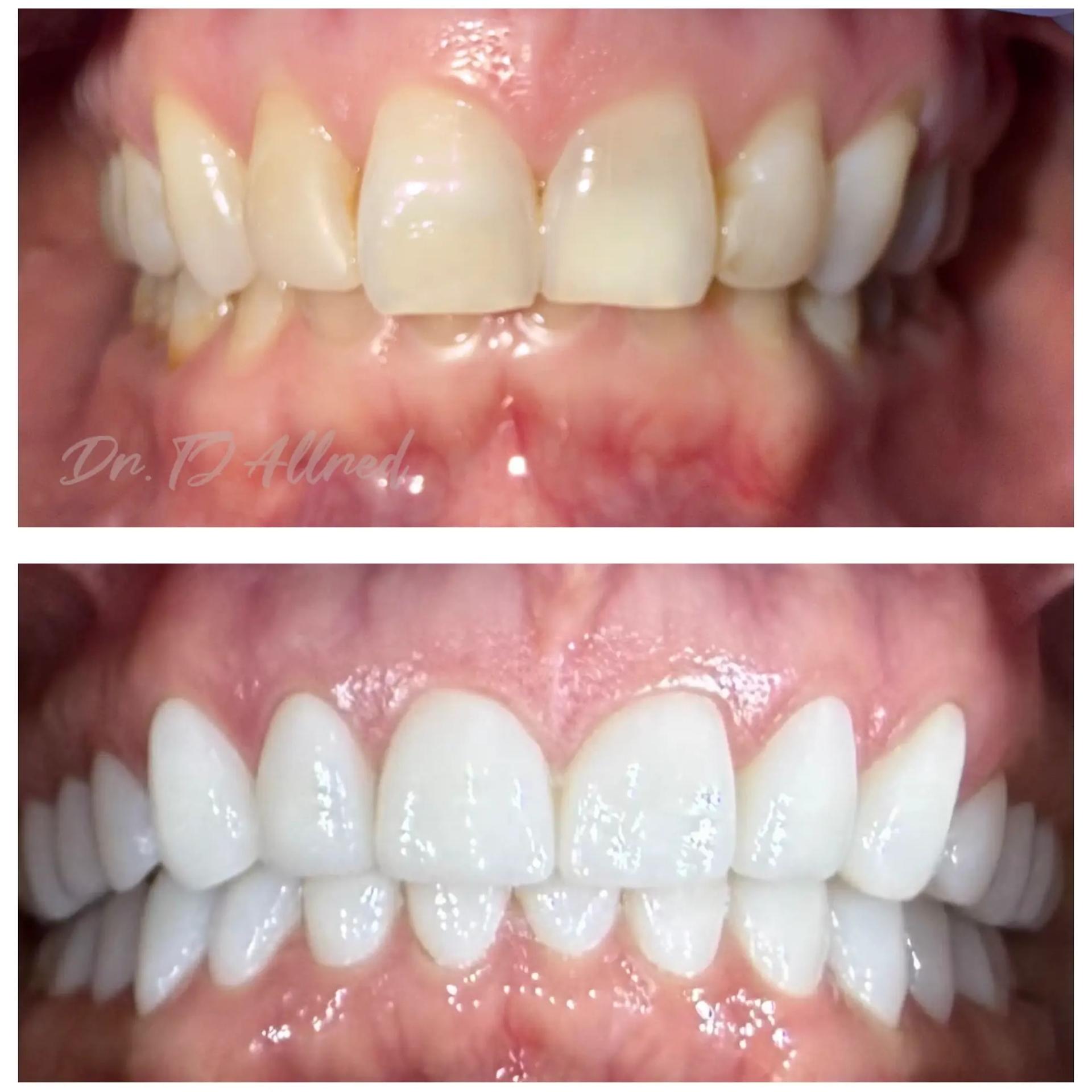 Velux Dental - SLC smile makeover result — Salt Lake City, UT