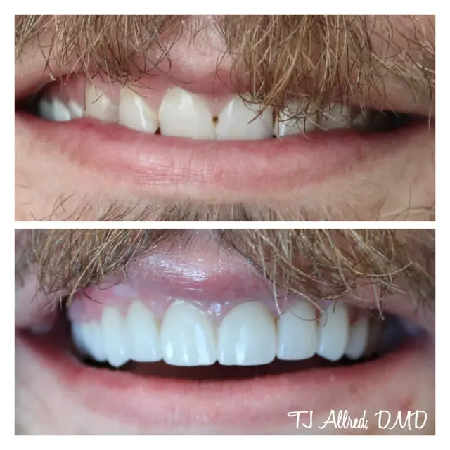 Smile Makeover result at Velux Dental - SLC in Salt Lake City, UT
