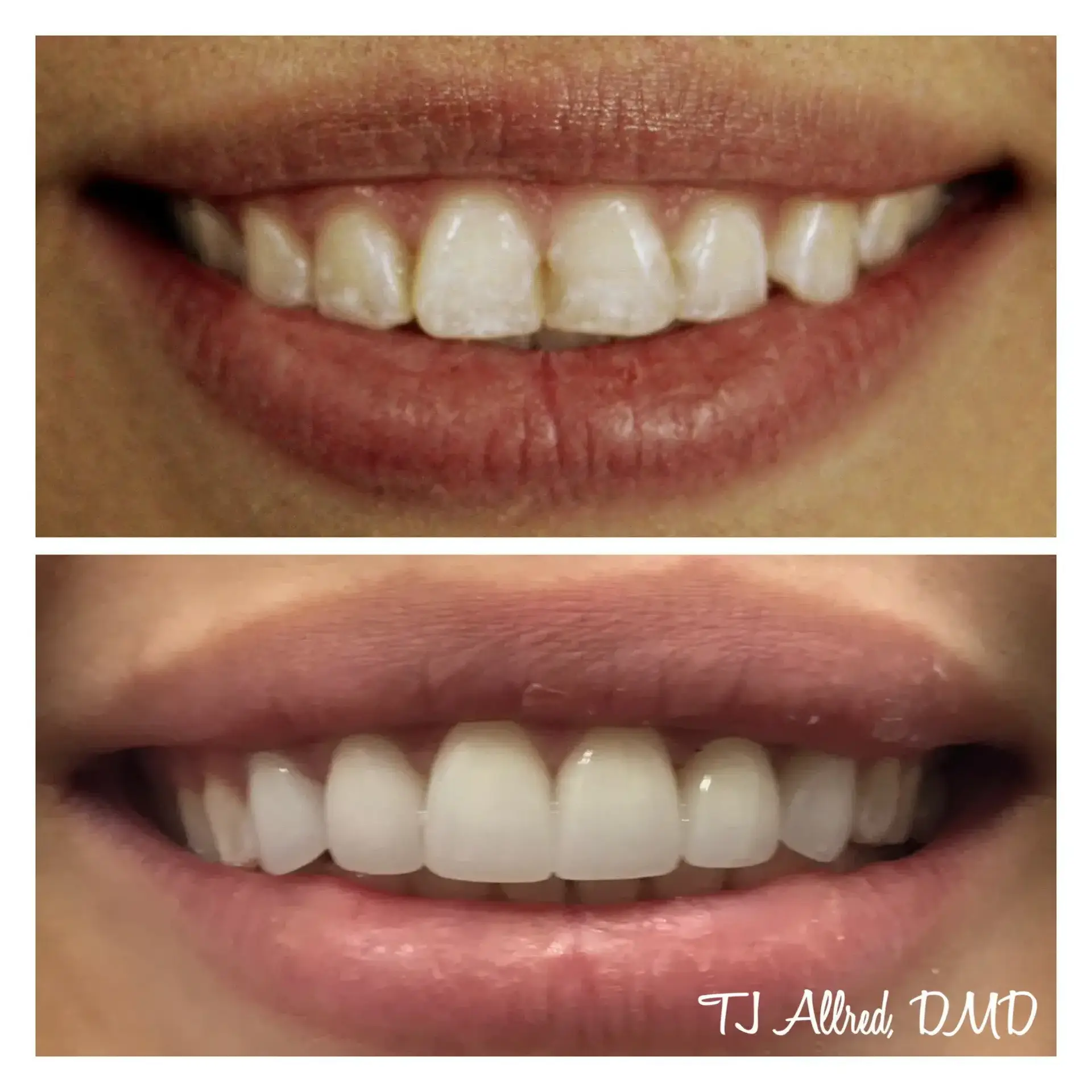 Velux Dental - SLC smile makeover result — Salt Lake City, UT