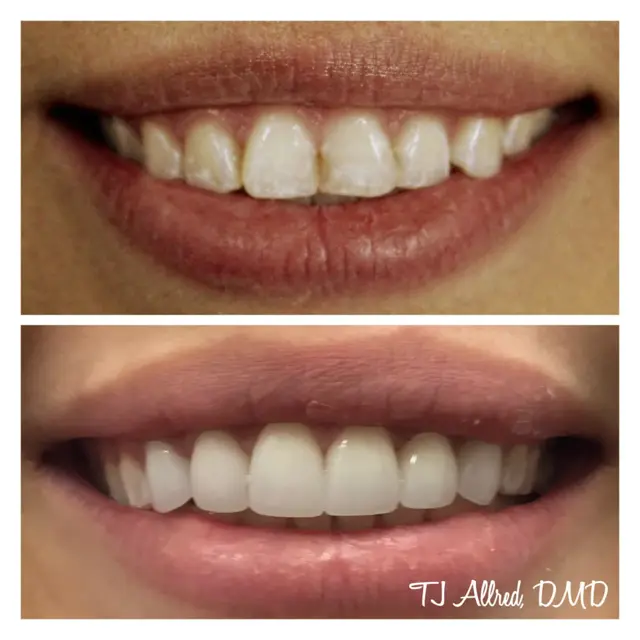 Smile Makeover result at Velux Dental - SLC in Salt Lake City, UT