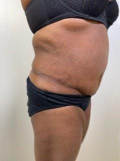 Mini Tummy Tuck before at Day Plastic Surgery (Norman Bakshandeh, MD) in Brooklyn, NY