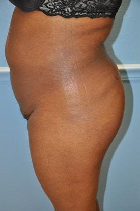 Brazilian Butt Lift after at Day Plastic Surgery (Norman Bakshandeh, MD) in Brooklyn, NY