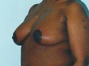 Breast Lift after at Day Plastic Surgery (Norman Bakshandeh, MD) in Brooklyn, NY