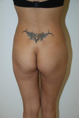 Brazilian Butt Lift before at Day Plastic Surgery (Norman Bakshandeh, MD) in Brooklyn, NY