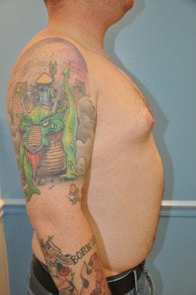 Gynecomastia Surgery before at Day Plastic Surgery (Norman Bakshandeh, MD) in Brooklyn, NY