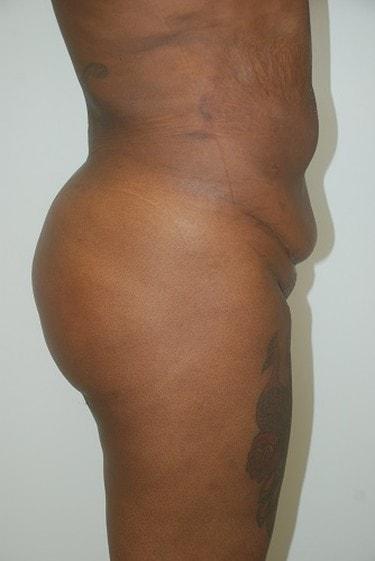 Brazilian Butt Lift after at Day Plastic Surgery (Norman Bakshandeh, MD) in Brooklyn, NY