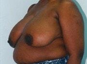 Breast Lift before at Day Plastic Surgery (Norman Bakshandeh, MD) in Brooklyn, NY