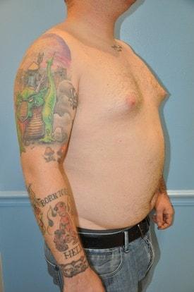 Gynecomastia Surgery before at Day Plastic Surgery (Norman Bakshandeh, MD) in Brooklyn, NY