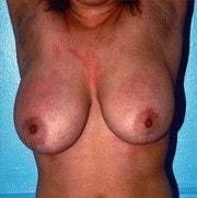 Breast Lift before at Day Plastic Surgery (Norman Bakshandeh, MD) in Brooklyn, NY