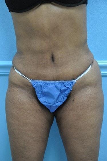Mini Tummy Tuck after at Day Plastic Surgery (Norman Bakshandeh, MD) in Brooklyn, NY