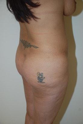 Brazilian Butt Lift before at Day Plastic Surgery (Norman Bakshandeh, MD) in Brooklyn, NY