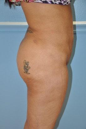 Brazilian Butt Lift after at Day Plastic Surgery (Norman Bakshandeh, MD) in Brooklyn, NY