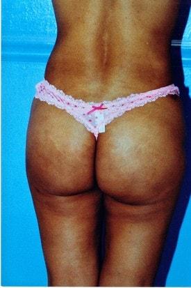 Brazilian Butt Lift after at Day Plastic Surgery (Norman Bakshandeh, MD) in Brooklyn, NY