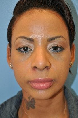 Day Plastic Surgery (Norman Bakshandeh, MD) rhinoplasty after — Brooklyn, NY
