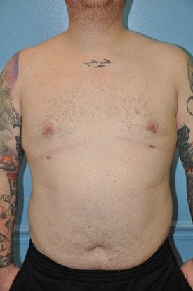 Gynecomastia Surgery after at Day Plastic Surgery (Norman Bakshandeh, MD) in Brooklyn, NY
