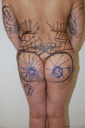 Brazilian Butt Lift before at Day Plastic Surgery (Norman Bakshandeh, MD) in Brooklyn, NY