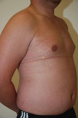 Gynecomastia Surgery after at Day Plastic Surgery (Norman Bakshandeh, MD) in Brooklyn, NY