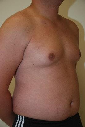 Gynecomastia Surgery before at Day Plastic Surgery (Norman Bakshandeh, MD) in Brooklyn, NY