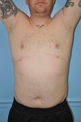 Gynecomastia Surgery after at Day Plastic Surgery (Norman Bakshandeh, MD) in Brooklyn, NY