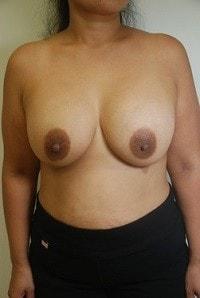 Day Plastic Surgery (Norman Bakshandeh, MD) breast augmentation after — Brooklyn, NY
